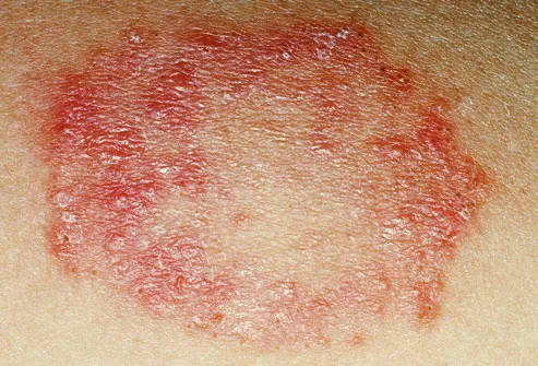 Pictures of Fungal Skin Infections