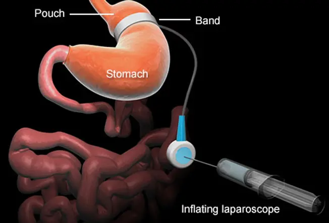Adjustable Gastric Banding (AGB or Lap-Band)