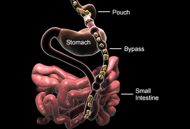 Creating the Stomach Bypass
