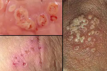 Herpeszvírus által okozott eruptionok a bőrön