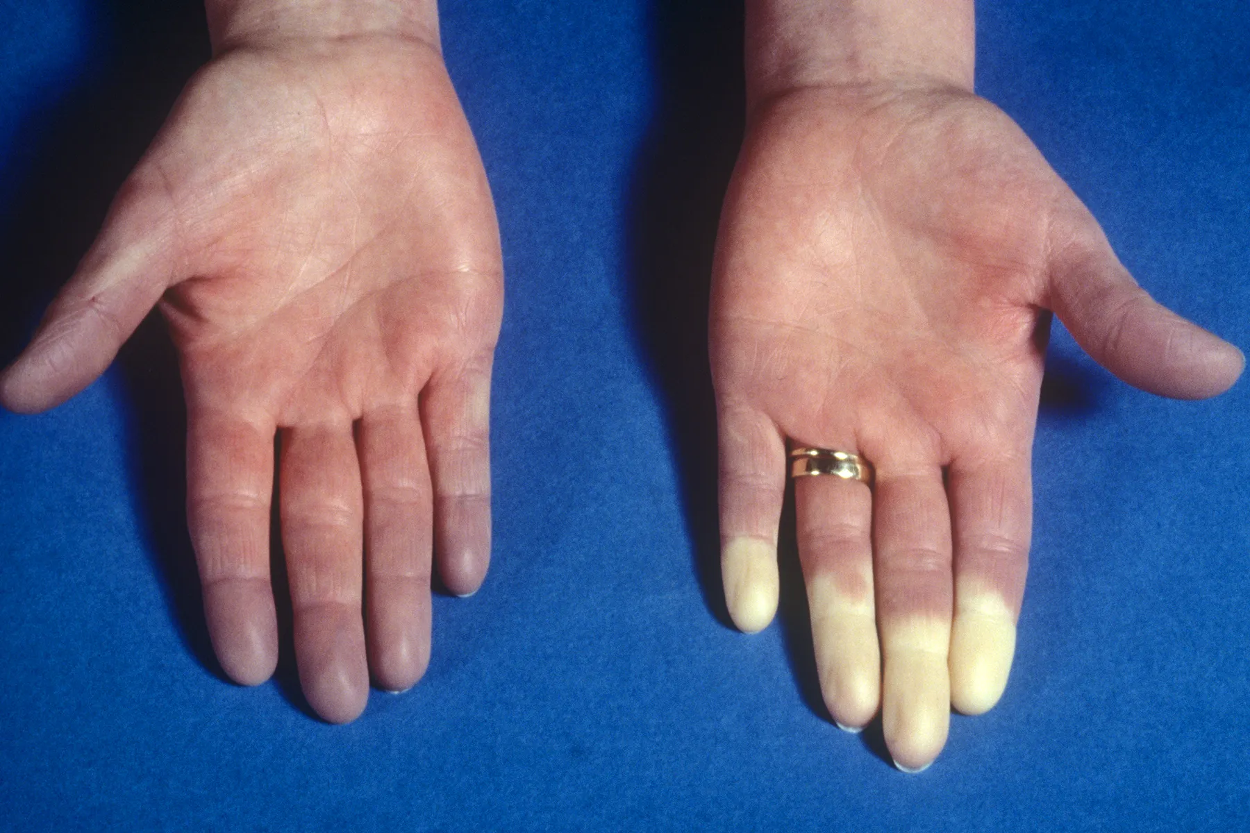 Raynaud S Phenomenon And Raynaud S Disease In Pictures