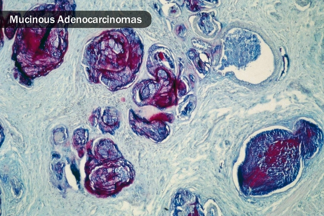 Type: Mucinous Adenocarcinomas