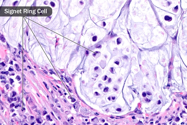 Type: Signet Ring Cell Carcinoma