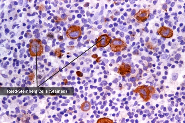 hodgkins lymphoma cells