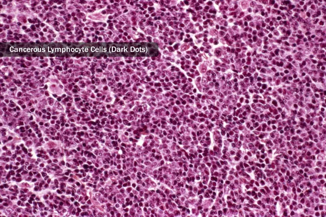 non hodgkins lymphoma cells