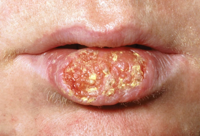 Type: Oral Cancer