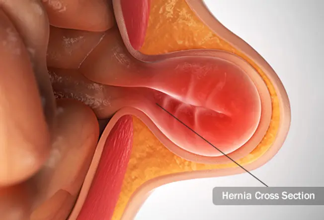 What Is a Hernia?