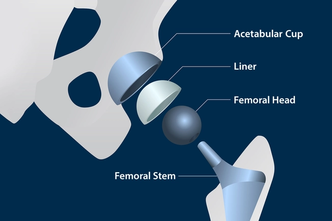 What’s in an Artificial Hip?