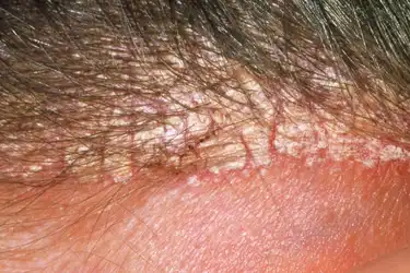 seborrhea capitis in adults vörös folt hámlik le az impetigo bőrt