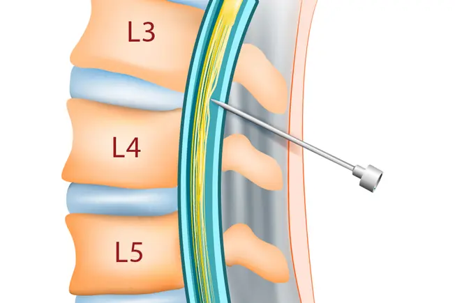 Spinal Tap Needle Insertion