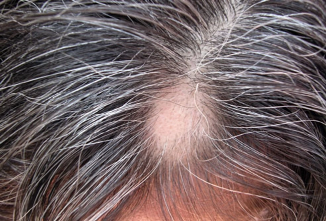 Hair Loss Trigger: Alopecia Areata
