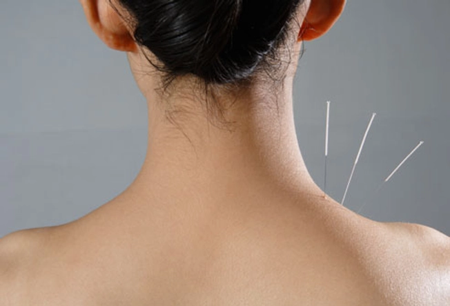 Give Acupuncture a Chance