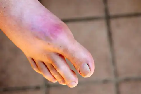 photo of gout on foot