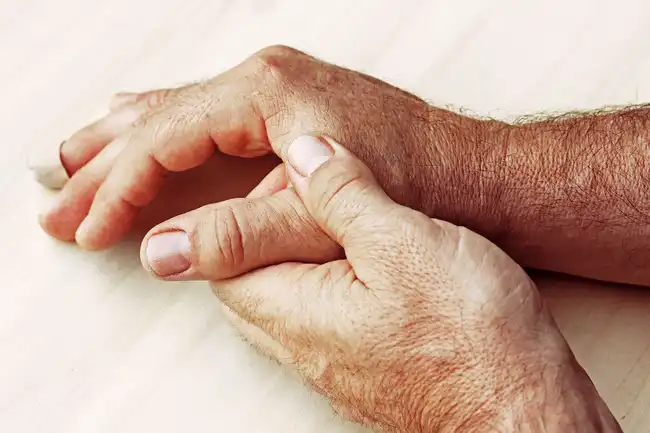 arthritic hands