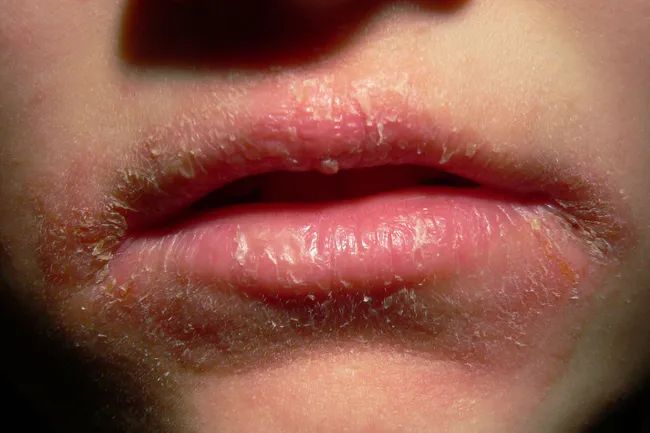photo of contact dermatitis around mouth