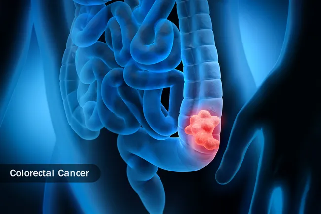 photo of colorectal cancer