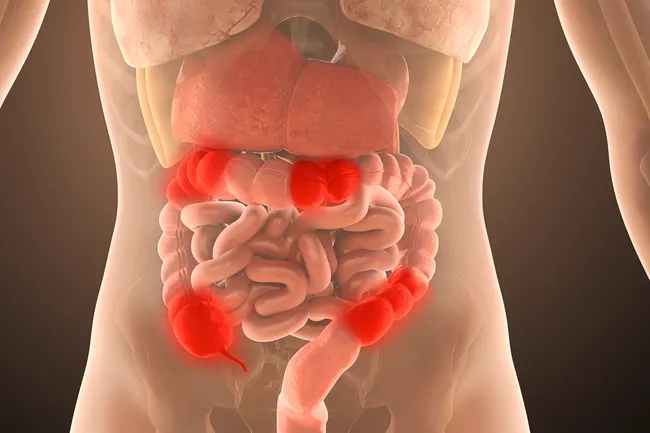 inflamed colon anatomy