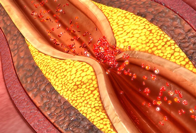 Hardened Arteries