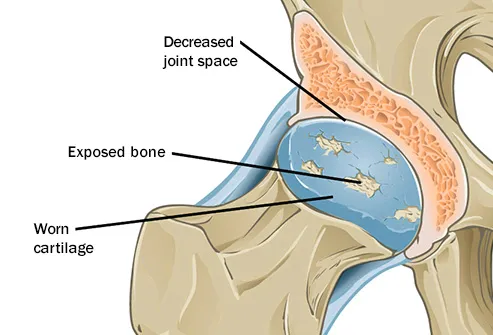 osteoarthritis illustration