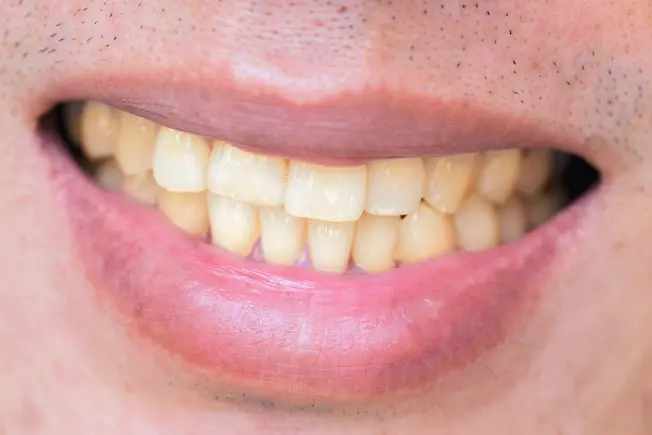 Teeth Stains