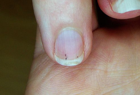 splinter hemmorage under fingernail