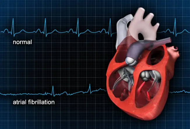 Irregular Heart Beat: Arrhythmia