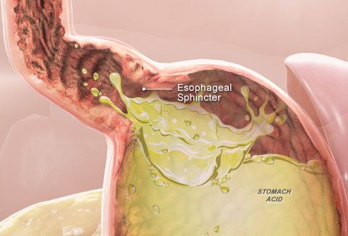 Heartburn Slideshow: Pictures of Heartburn Causes ...