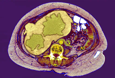 CT Scan Of A Cancerous Liver