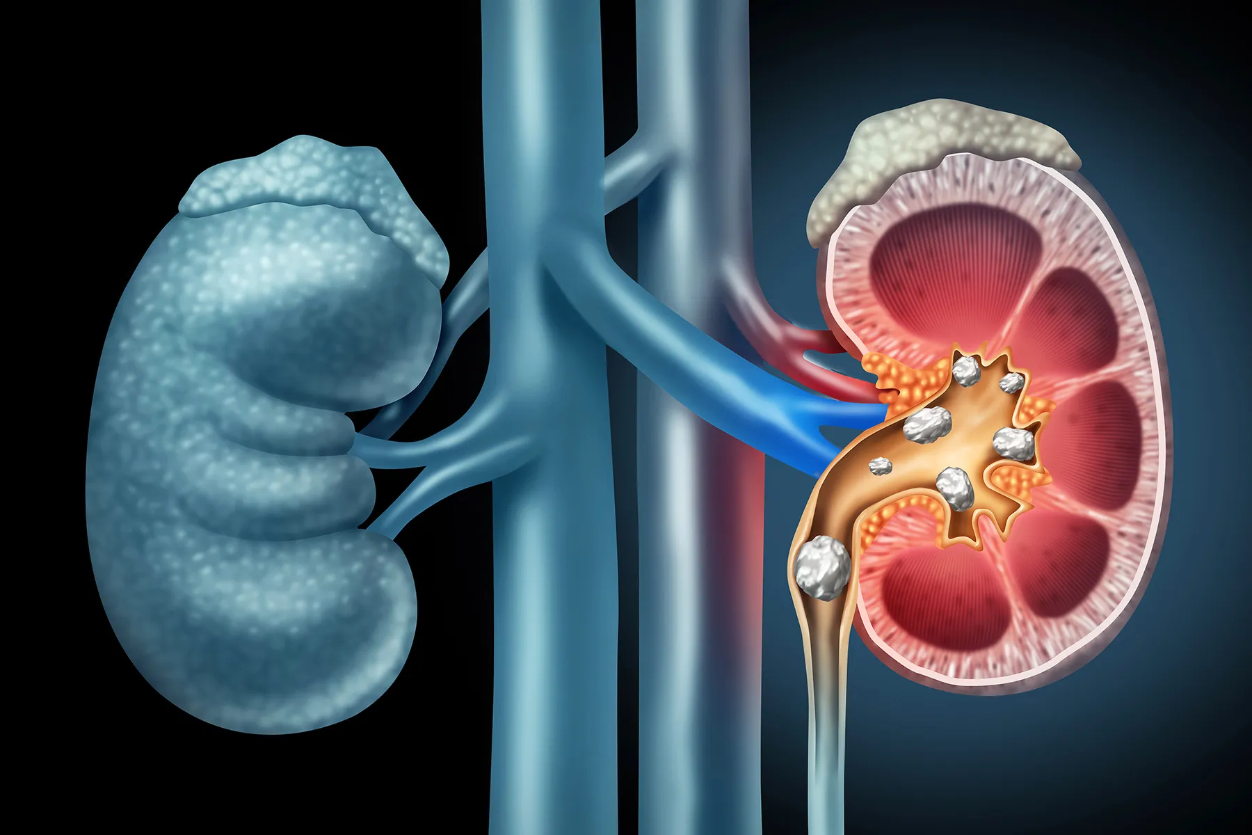 photo of kidney stones anatomy