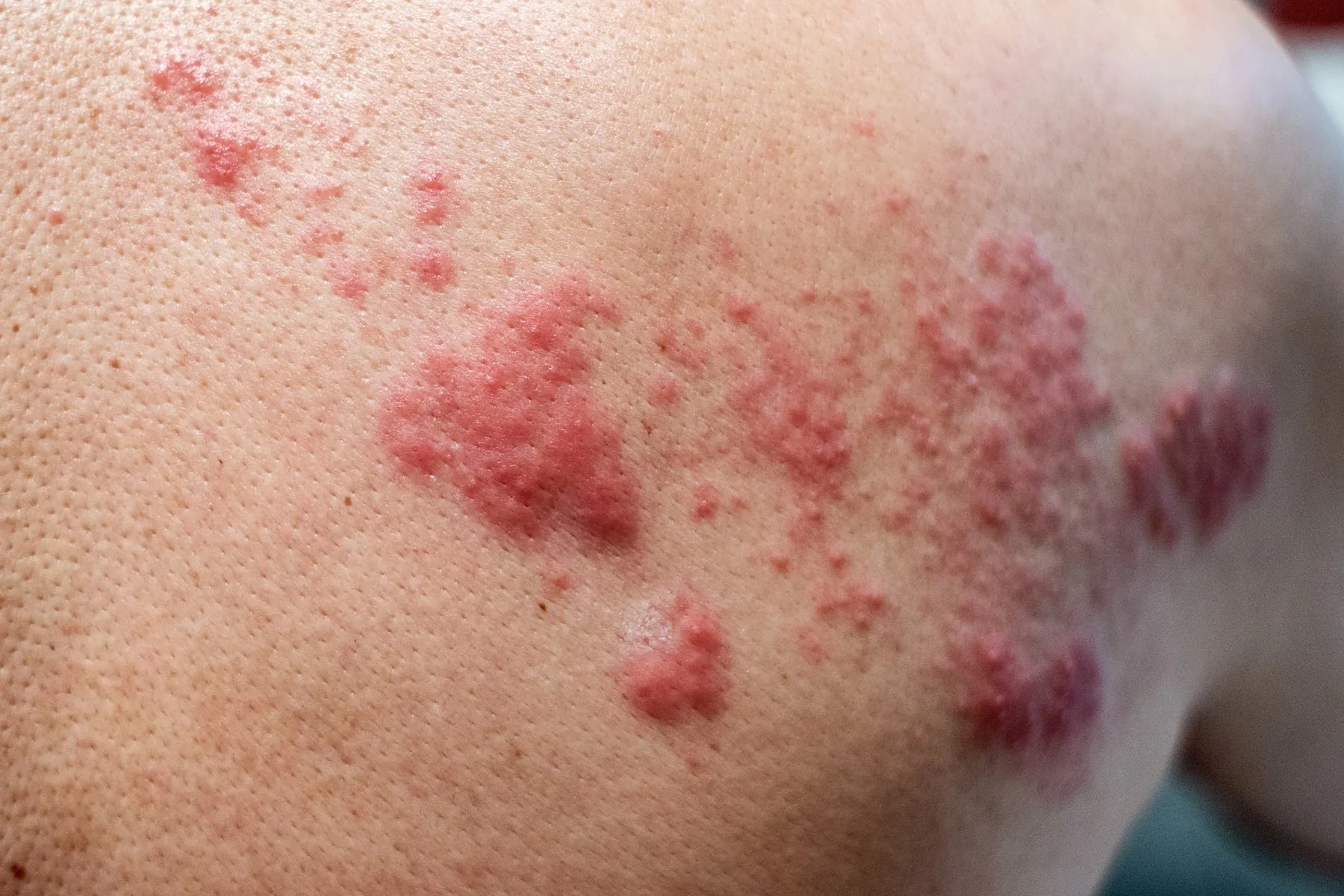 warts on skin rash