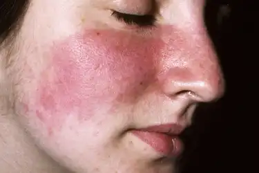 hpv skin rash on face)