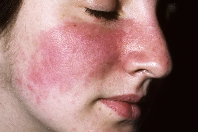 Slideshow Hiv And Aids Rashes And Skin Conditions