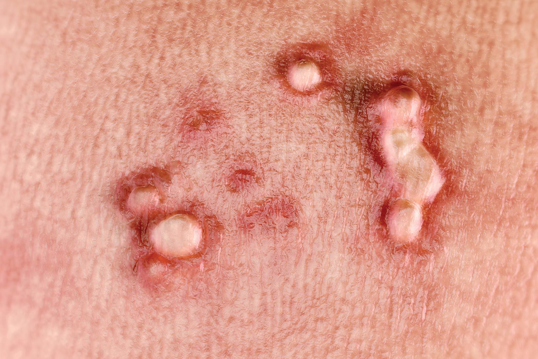 Warts on hands sign of hiv. Translation of 