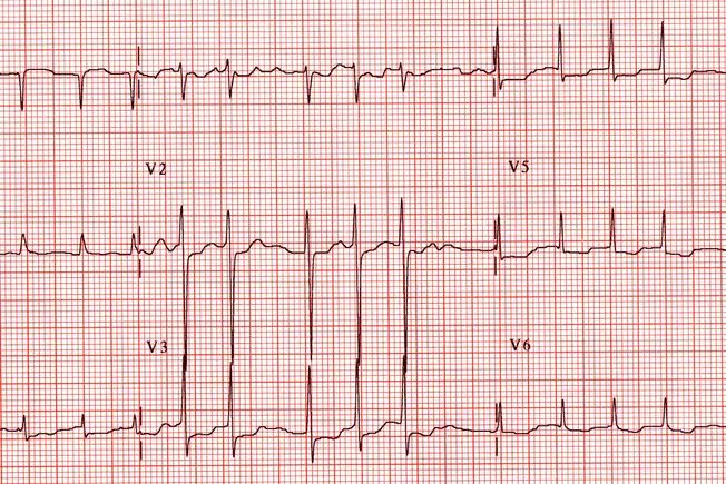 Các vấn đề về tim ở người cao tuổi - 1800ss science source rm ekg revealing atrial fribrillation