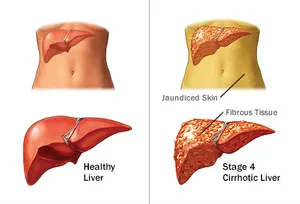 healthy vs cirrhotic liver