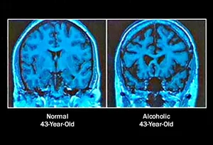 normal vs alcoholic brain