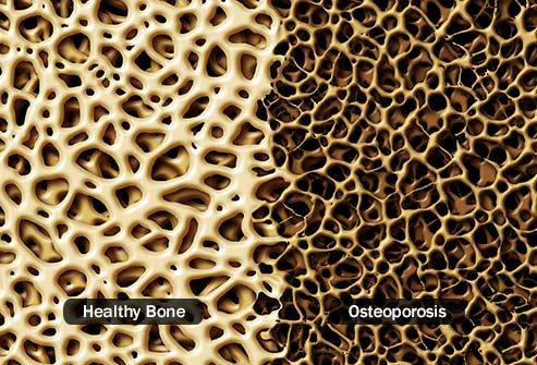 healthy bone vs osteoporosis
