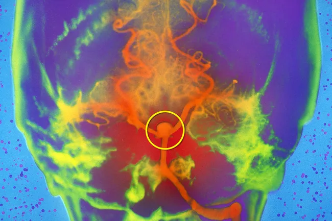 aneurysm brain scan