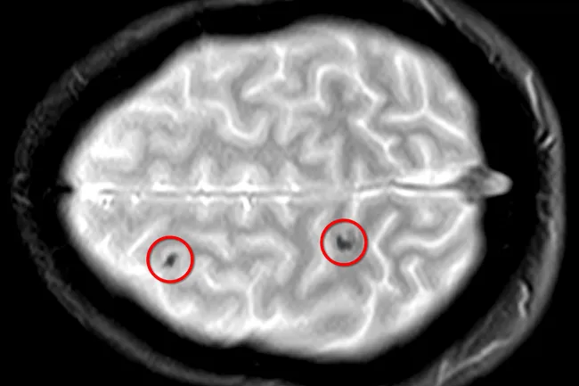 concussion brain scan