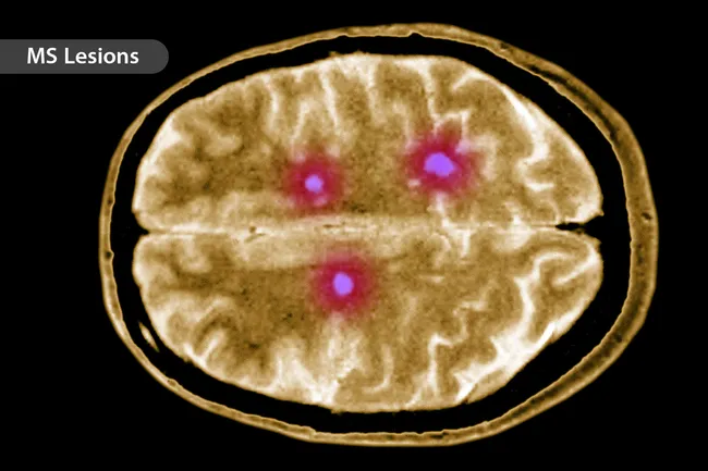 multiple sclerosis brain scan