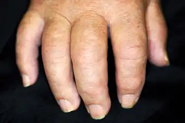 Psoriasis arthritis jelei