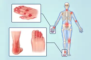 is psoriatic arthritis an inflammatory disease