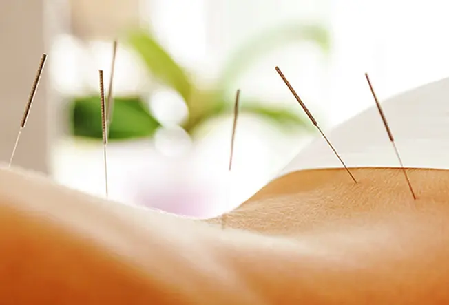 Give Acupuncture a Try