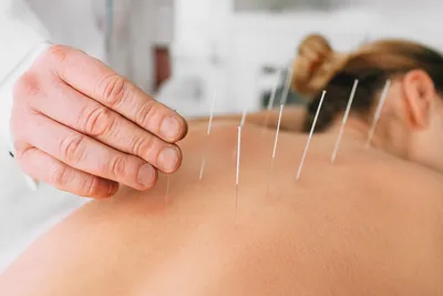 photo of acupuncture