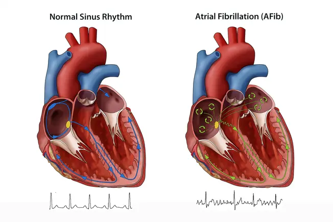 What Is AFib?