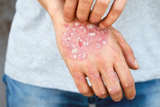 photo of psoriasis on hands