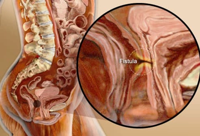 Complications: Abscess or Fistula