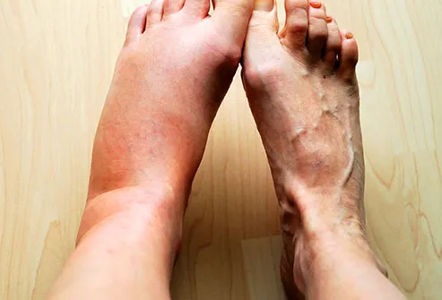 swollen ankle