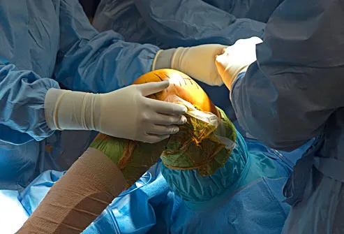 knee cap operation