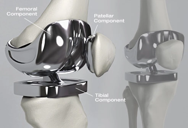 What Is Knee Replacement?